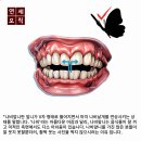 공산치과의원 | 중랑구 교정치과, 나비앞니와 돌출입 치아교정으로 잡을수 있나요?