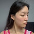 하얀마음한의원 | 수원편평사마귀제거 쥐젖제거 무제한 후기