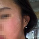 천안모공치료 새살침산삼엑소좀 천안해율한의원 내돈내산 후기