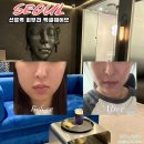 엑셀고급 | 선릉역피부과 엑셀웨이브 리프팅, 턱선 라인 달라진 내돈내산 후기
