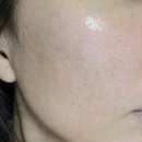 다나피부과의원 | 김해 피부과 스킨부스터 셀르디엠 후기 피부결 좋아진 예신관리