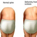 온누리메디칼의원 | [온누리메디칼의원] 정확한 진단이 필요한 척추 측만증