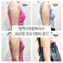 망포로 | 망포 팔뚝지방분해주사 내돈내산 팔뚝제로팻주사 5회차 끝난 후기 보여드려요