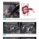 장염 (Enteritis) 이미지