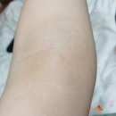 41번길약국 | [화폐상습진] 투병 완치 후기 5편 (Feat. 알레르기 결막염)