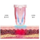 용산-300 | [용산피부과] 예비신부 리프팅 추천 볼뉴머 300샷 후기