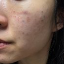 리즈멍 | 대구 리쥬란 HB, 리즈네 내돈내산 시술 일주일 변화 후기