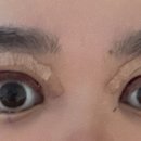 스케치성형외과의원 | [서울 신사역 ㅂㅇㅇㅇ 성형외과의원 ㅎㅅㅍ 원장] 안검하수,쌍커풀 상담 수술 후기 2탄