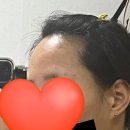 [커클랜드 미녹시딜 5%] 엠자이마 + 마빡이 탈모 1년 사용 후기 🧴🫠