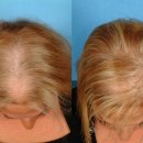 촘촘 스칼프 이미지