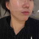 울산광고 | 울산울쎄라 써마지 리프팅 내돈내산 후기 (광고일절x)