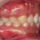 UR(인천광역시 남동구)-[논현로]-상-20 | 투명교정 인비절라인라이트 치료후기 _ 어느 정도까지 라이트로 치료 가능할까