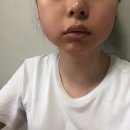 바른선치과의원 | 턱관절 5년 내돈내산 치료 후기 (스플린트, 관절강세척술, 교근신경차단술, 한의원, 보톡스, 약물치료)