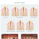 골절 진단비 특별약관과 골절 진단비(치아 파절(깨짐, 부러짐)제외) 특별약관의 골절분류표 비교 이미지