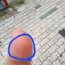 엄지손가락 지문부위에 물혹 이미지