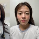 에스비피부과의원 | 내돈내산 쥬베룩 볼륨 3회차 후기 (팔자주름, 앞볼, 옆볼) | 만족도, 통증, 당일시술후기