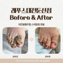 금산목욕탕 | [대전발톱무좀]목욕탕에서도 양말 못 벗던 80대 어머니, 자녀들의 효도 선물로 해결!