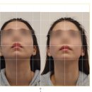 7554 | 청담 예신관리 안면비대칭관리로 유명한 보나트페이스 후기