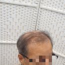 김호증모가발by헤어리서치 이미지