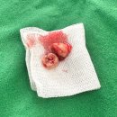 박성용치과의원 | [목포 치과추천/ 박성용치과의원] 매복사랑니 발치했어요 :)