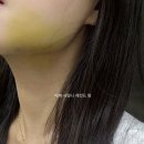 한림대학교춘천성심병원 | 한림대학교 춘천성심병원 | 매복 사랑니 발치 후기 | 일주일간의 기록
