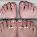 시연 메디케어 | 부안,진안에서도 찾아주셔서 감사합니다 문제성 무좀,내성의 성지!! 아이슈네일 고객후기!!