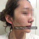 용한의원 | 리유한의원 치료 5개월 정도 받아보고 완치했네용~