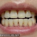 (주)덴티움 | 2차 잇몸필러 내돈내산 솔직후기/잇몸필러 덴티움 모나리자/블랙트라이 앵글 고민