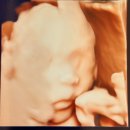 아산우리약국 | [임신] 21w3d 아산병원 정밀초음파 검진 후기 (원혜성교수님, 결과, 비용, 수술일예약)