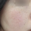 1006 | 루나의원 루비레이저 내돈내산 후기 | 1006방 ^0^ | 주근깨 | 기미 | 잡티 | 당일~1개월 경과 추가