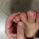 레푸스수성점 | 대구내성발톱 축구하는 남자아이 발톱 교정 후기(feat.레푸스 수성점)