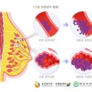 유방확대(다만, 유방암 환자의 유방재건술은 보상합니다)·축소술[실손의료비보험 2016년 1월 이후] 이미지