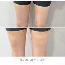 (주)성수검사정비 | 성수다이어트병원 제로펫 주사 3회차 내돈내산 솔직 후기 통증, 기간
