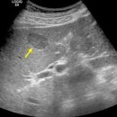 Liver calcified nodule 이미지