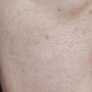 양의원 | [미용] 루나의원 - 루비레이저 1달 후기