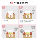 밝은 미소 만들기 대방동 연세예울치과:유지장치 탈락의 원인과 예방