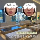 [일원3] 나도 부동산 전문가가 될 수 있다 (A) | [시청역 명동피부과] 쥬베룩 볼륨 옆볼 3회차 솔직 후기 (효과, 통증, 가격)