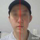용치과의원 | 안면비대칭 교정 치과 턱교정 15개월 차 후기
