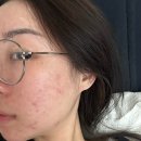 처인한의원 | 처인구 에스테틱 가격 대비 만족도 높은 여드름 관리 정착 후기