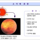 유리체 출혈 이미지