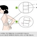 허리디스크란?(What is a herniated disc?) 이미지