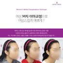 차 앤 박 헤어 | 여성 M자 헤어라인 이렇게 달라졌어요｜미국 거주 환자 후기