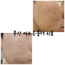 해당한의원 | 내돈내산 부산 서면역 흉터치료 한의원 새살침 솔직후기