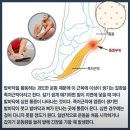 족저근막의 위치와 족저근막염이 발생하는 원인 - 발가락사랑 이미지