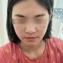 후안대구수성 | 대구콜드플라즈마 : AI 콜드플라즈마 기미 주근깨 잡티 제거 후기 (1주일 -2주일 )