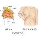 칼만 증후군[Kallmann syndrome]신장비뇨기질환, 여성질환, 유전질환 이미지
