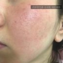 리유한의원 | 리유한의원 신사점 후기 심부재생치료 6개월