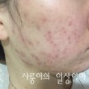 임한의원 | (마지막)모낭염 리유한의원 후기 내돈내산