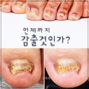 안산 중앙역 내성발톱, 발각질, 무좀발톱 친구들이 추천해준 네일죤 후기