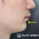 이원치과의원 | 무턱교정 “발치교정을 반드시 해야 하나요? (남자분 비발치 교정 후기)